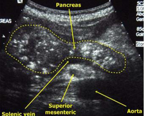 만성 췌장염(Chronic pancreatitis): 진단 - Metamedic