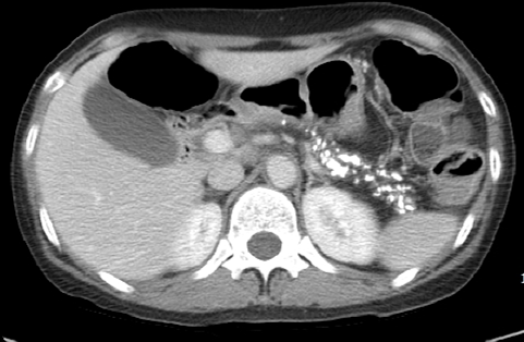 만성 췌장염(Chronic pancreatitis): 진단 - Metamedic