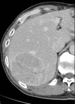 기타 간 종양: 양성 간 종양(benign liver tumors) - Metamedic