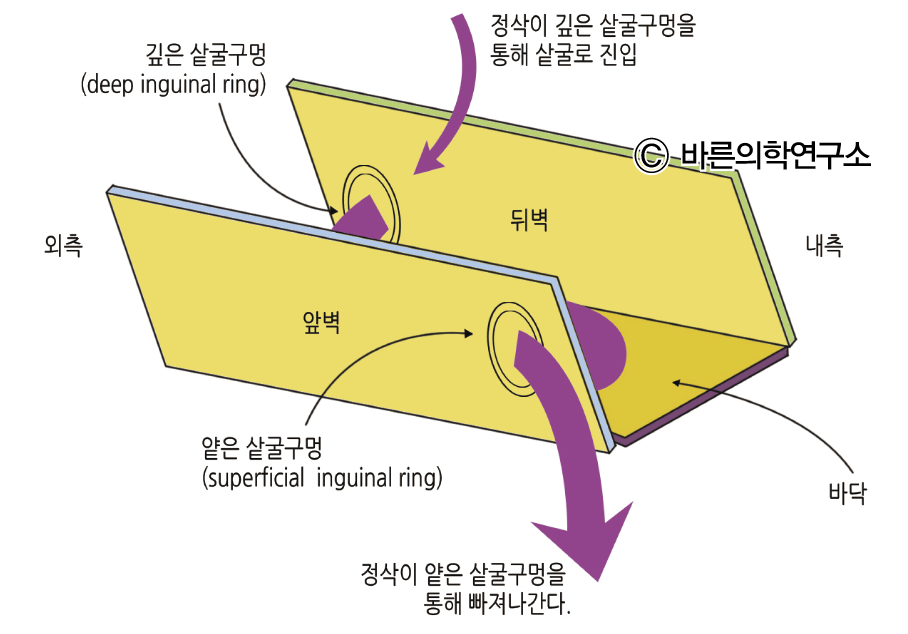 탈장: 서혜부 탈장 - Metamedic