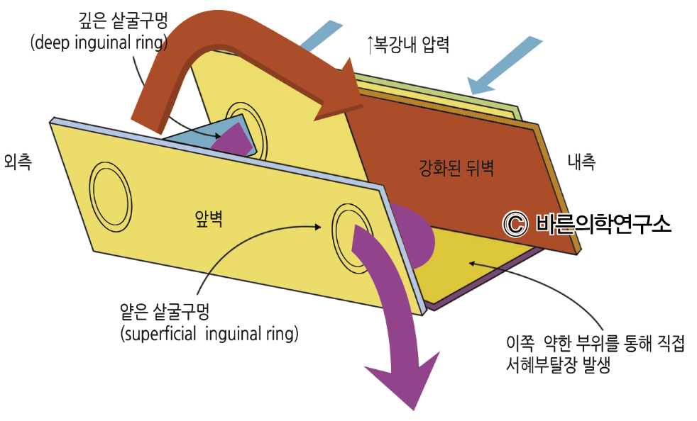 탈장: 서혜부 탈장 - Metamedic