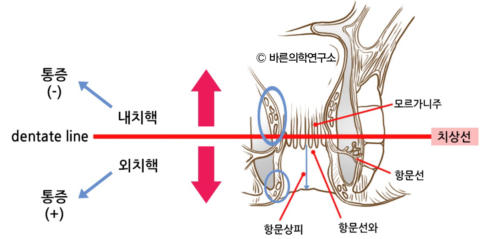 주요 항문질환: 치핵(Hemorrhoids) 등 - Metamedic