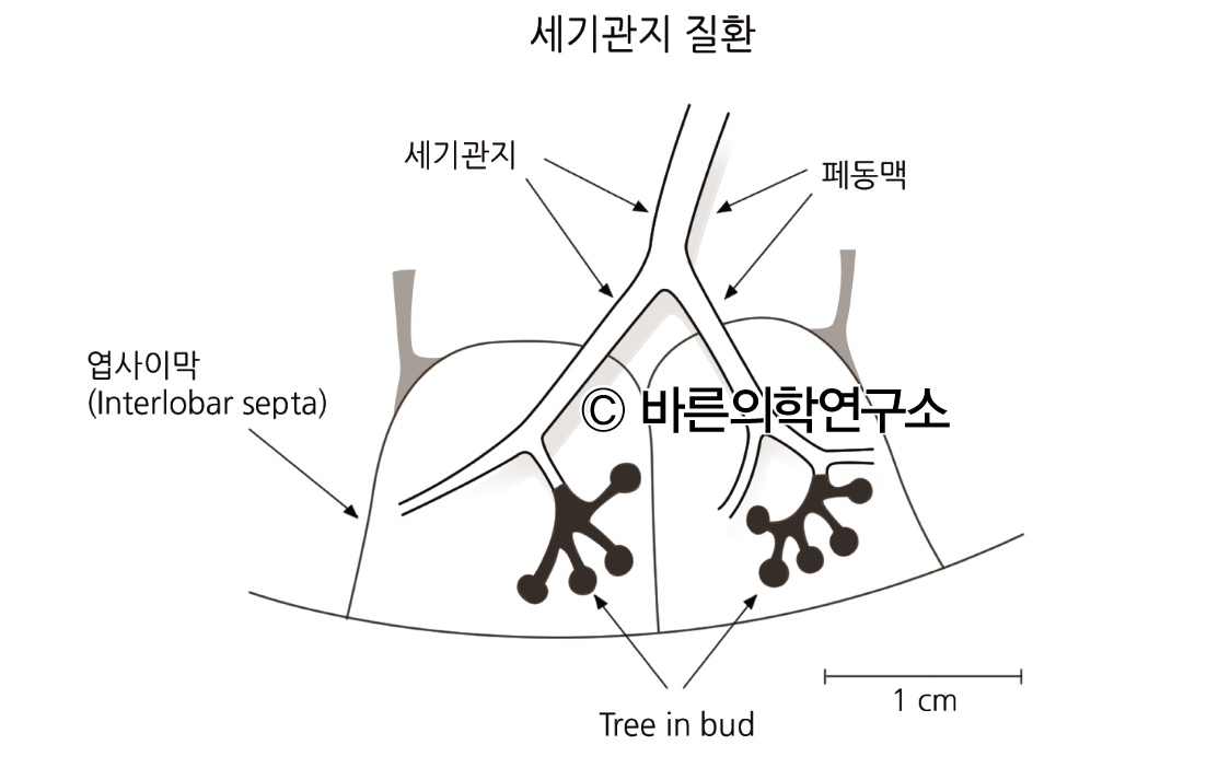 폐결핵: 진단 - Metamedic