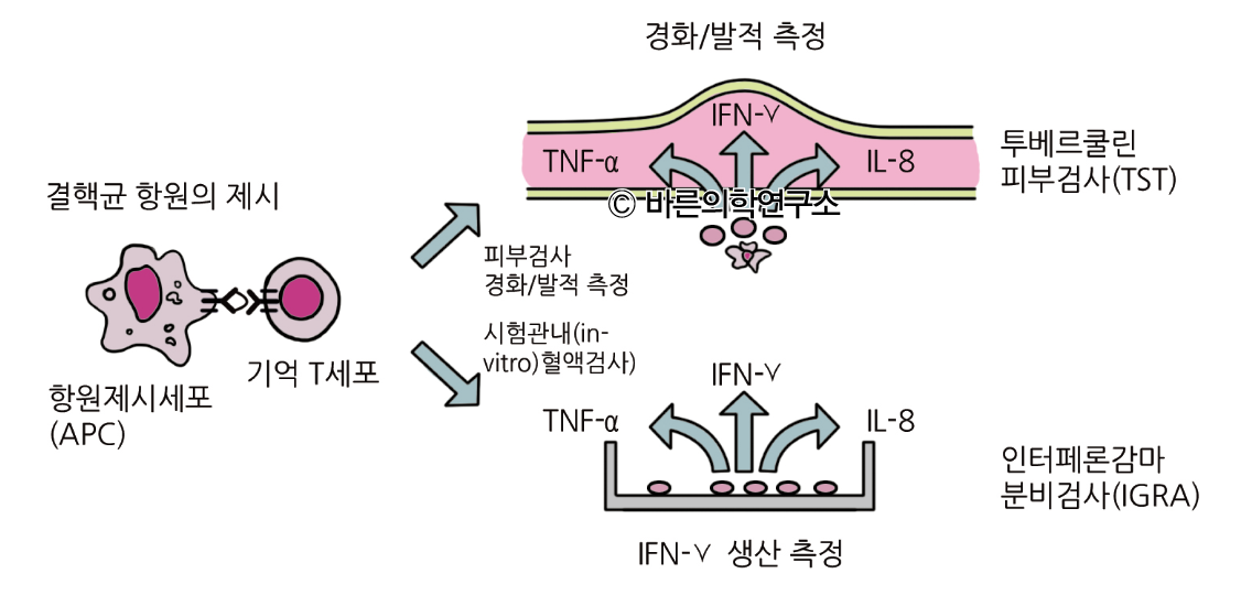 폐결핵: 진단 - Metamedic