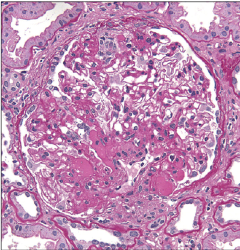 국소 토리 굳음증(Focal segmental sclerosis, FSGS) - Metamedic
