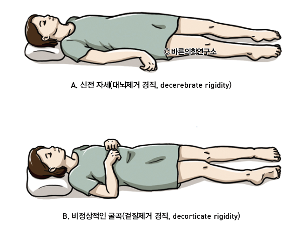 의식장애환자의 신경학적 검사 - Metamedic