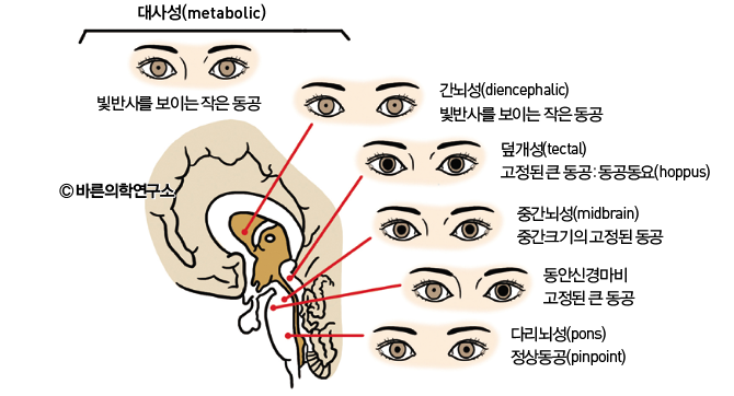 의식장애환자의 신경학적 검사 - Metamedic