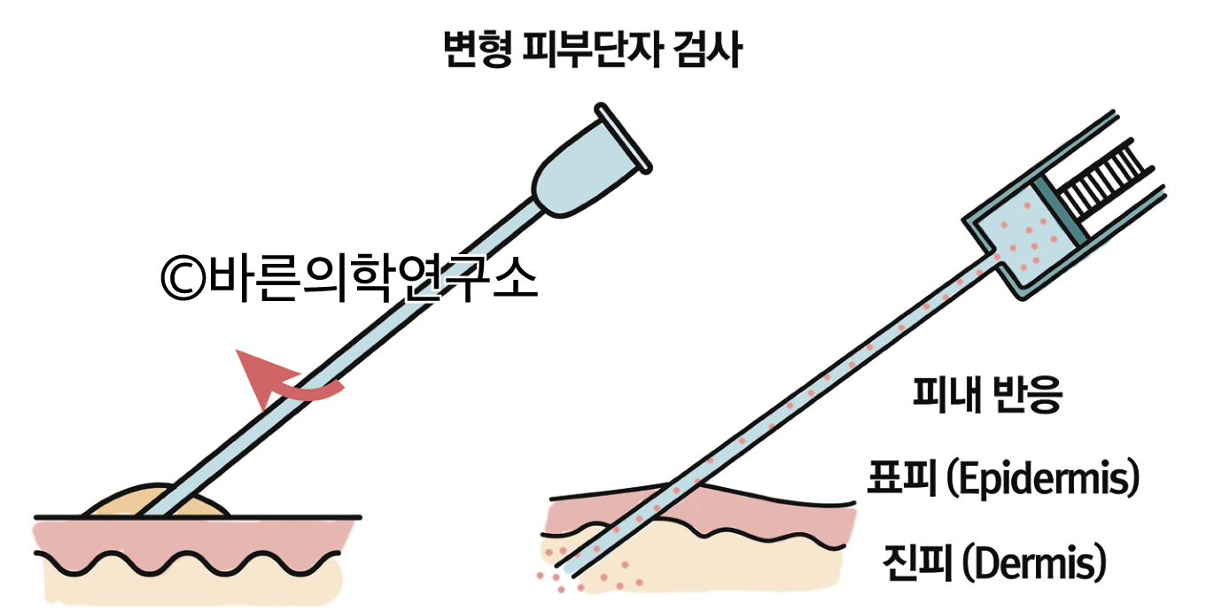 알레르기 비염: 진단 - Metamedic